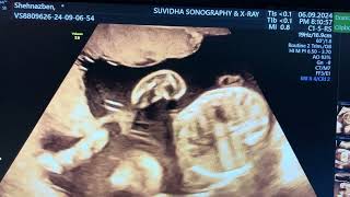 Lambda Sign in twins prrgnancy dichorionic diamniotic twins pregnancy [upl. by Quinta16]