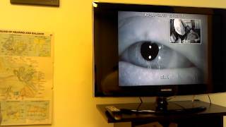 Eye Video Downbeat Nystagmus [upl. by Velasco]