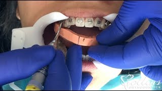 How Braces are Put On Teeth  New Faster Technique Indirect Bonding [upl. by Ras]