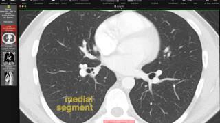 Lobar and Segmental Lung Anatomy on CT [upl. by Amaral]