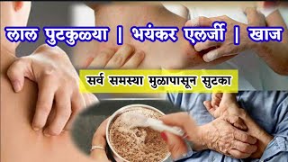 लाल पुटकुळ्या  भयंकर एलर्जी  खाज सर्व समस्या मुळापासून सुटका  Khaj yene gharguti upay [upl. by D'Arcy]