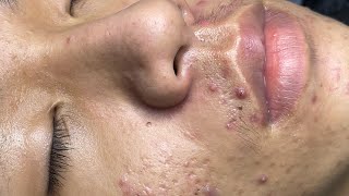 ACNE TREATMENT VU QUYNH MI Blackheads On Boy Face 2024 [upl. by Tibbitts]