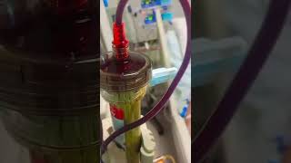 Plasmapheresis  YouTube viralshorts video [upl. by Nawk]