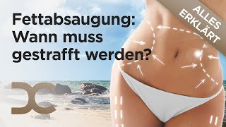 Muss die Haut nach der Fettabsaugung immer gestrafft werden  Dorow Clinic QampA [upl. by Aloz807]