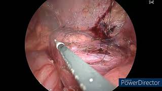 Laparoscopic ureteroureterostomy for mid ureteric obstruction [upl. by Koral873]