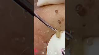 Skincare  Blackheads Removal 182 skincare skincare blackheads blackheads [upl. by Perdita]