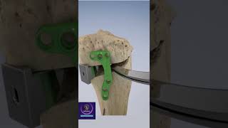 Osteotomy for Osteoarthritis shorts [upl. by Nesila]