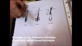 électrolyse epilation par la thermolyse explication [upl. by Hunter]