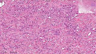 Lobular Carcinoma Breast  Histopathology [upl. by Belle]