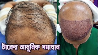 Best Hair Treatment in Bangladesh  টাক মাথায় চুল প্রতিস্থাপন [upl. by Cissiee212]