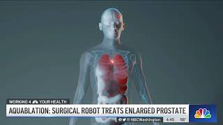 News4 at 4  Aquablation Surgical Robot Treats Enlarged Prostate [upl. by Enitram600]