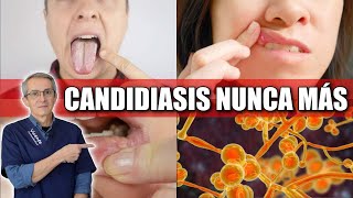 CURA DEFINITIVA para el hongo CANDIDA ¡sorprendente y natural [upl. by Netniuq]