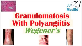 Granulomatosis with Polyangiitis Wegener’s granulomatosis  Symptoms Diagnosis Treatment [upl. by Yila721]