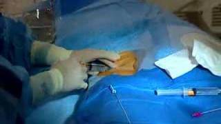 Live Webcast Cardiac Catheterization Angioplasty amp Stent [upl. by Borer]