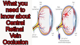 Central Retinal Vein Occlusion CRVO Blurred visionEye pain [upl. by Allicserp]