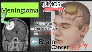 Meningioma brain tumor ba ito ano ang dapat mong malaman watch the video [upl. by Vergil]