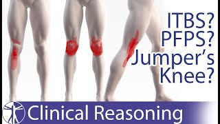 Atraumatic Knee Pain Differential Diagnosis  ITBS PFPS Jumpers Knee [upl. by Alael]