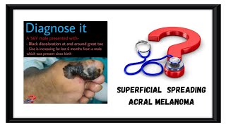 Superficial spreading Acral Melanoma [upl. by Jens892]