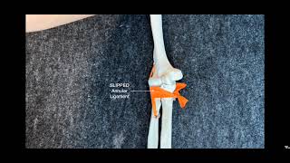 How to do a Nursemaids Elbow Reduction [upl. by Yelsiap896]