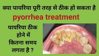 Pyrrohea treatmentक्या पायरिया पूरी तरह ठीक हो सकता हैपायरिया का इलाज tartar removalcalculus [upl. by Erhart]