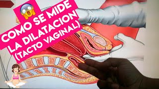 ¿Cómo se mide la DILATACIÓN​ 🤞🏼🏥 TACTO VAGINAL  2021 [upl. by Gene]