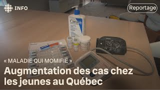 Augmentation des cas de la « maladie qui momifie » au Québec [upl. by Attem349]