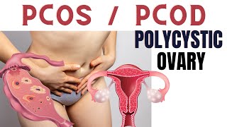 PCOS symptoms and treatment  Polycystic ovary syndrome in Hindi [upl. by Donetta]