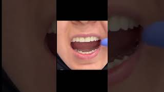 smile transformation with zirconia teeth shortvideo prettyface dentalvideos prettygirl [upl. by Feucht]