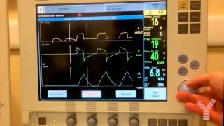 Maximum Inspiratory Pressure MIP or Negative Inspiratory Force NIF on Maquet Servoi [upl. by Aisan]