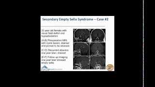 Empty Sella Syndrome [upl. by Deanne]