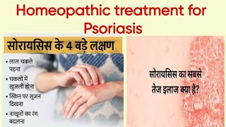 Psoriasis को जड़ से मिटाने वाली दवाई  Best treatment of psoriasis in homeopathy  सोरायसिस का इलाज [upl. by Erdied]