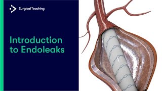 Introduction to Endoleaks  What Every Medical Student Needs to Know [upl. by Rucker495]