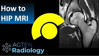 How to read Hip MRI [upl. by Bidget]