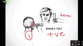 Rinnes test  Tuning Fork Tests  ENT [upl. by Llevram]