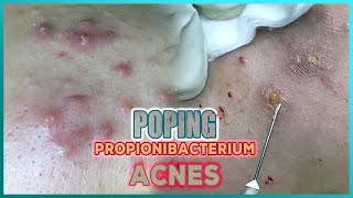 Big Cystic Acne Blackheads Extraction Blackheads amp Milia Whiteheads Removal Pimple Popping [upl. by Aremat623]