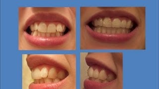 INVISALIGN Update Tray 21 last tray amp Refinements [upl. by Brian]