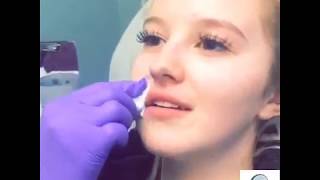 Lip Flip Procedure by Dr Caroline Chang Board Certified Dermatologist [upl. by Notlad]