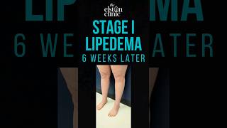 LIPOSUCTION FOR LIPEDEMA  STAGE 1 LEGS AND KNEES lipedema [upl. by Yorle110]