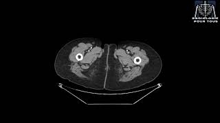 SCANNER ABDOMINOPELVIEN Polykystose hépatorénale [upl. by Baram446]