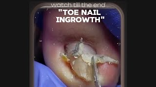 quotThe Painful Truth About Ingrown Toenails—And How to Stop It Fastquot [upl. by Winther]