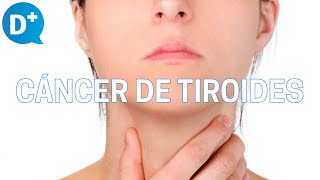 Cáncer de tiroides Qué es por qué se produce y cómo se trata [upl. by Atiugram252]