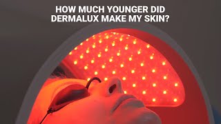 See what Dermalux Flex did for my skin  Alice HartDavis [upl. by Merla]