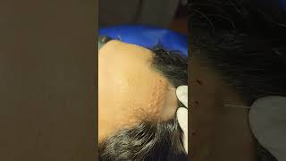 Steroid injection for Alopecia Areata [upl. by Oisangi]