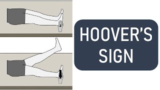 Hoovers Sign  Hoover Test [upl. by Tijnar]