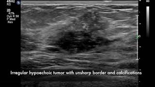 Breast ultrasound  cancer [upl. by Ferrell]