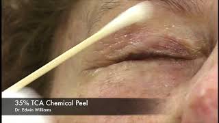 35 TCA Chemical Peel by Dr Edwin Williams for Wrinkles amp Sun Damage [upl. by Nai269]