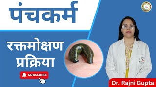 Raktamokshana  Best Ayurvedic Treatment For Skin Diseases [upl. by Cut]