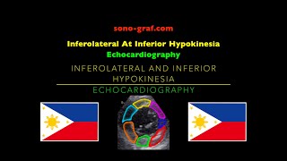 Echocardiography  Inferolateral At Inferior Hypokinesia [upl. by Erin277]