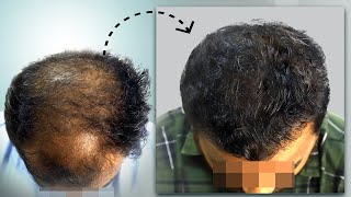 8Month Transformation Grade 6 Baldness to Full Hair 💥  Hair Transplant in Vashi  New Roots [upl. by Saied625]