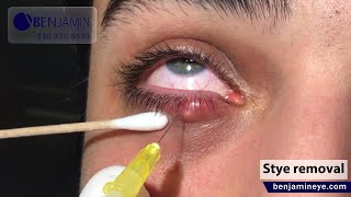 Styes may require surgical intervention to drain the pus and alleviate pressure on the eyelid [upl. by Beuthel]